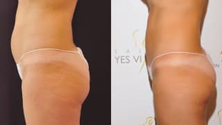 Photo - SlimLipo Laser Liposuction, Cryolipolysis - Ivana