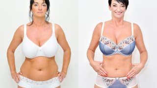 Photo - SlimLipo Laser Liposuction - Juliana