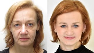 Photo - Facelift - Jitka