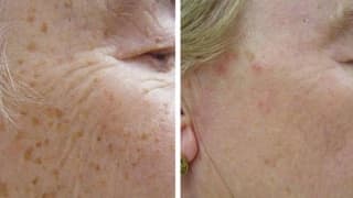 Removal of pigment