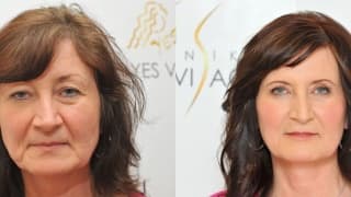 Photo - Eyelid surgery - Ivana