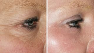 Wrinkle smoothing