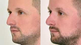 Photo - Rhinoplasty - Jakub