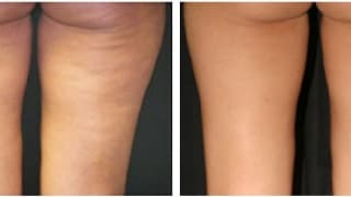 Cellulite removal