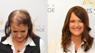 Photo - Sparse hair and lysine solution - Zuzana