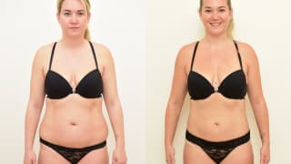 Photo – SlimLipo Laser Liposuction – Tereza