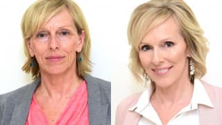 Photo - Fillings, botox and 4D laser - Hana