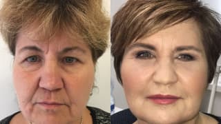 Photo – Facelift - Renata