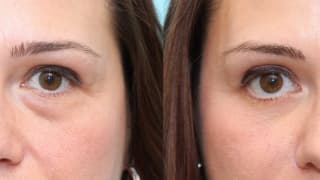 Lower eyelid surgery