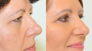 Photo - Eyelid surgery - Alena