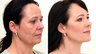 Photo - Fillers, Eyelids - Dagmar