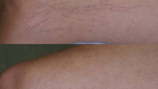 Removal of veins and catheters