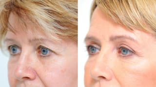 Photo - Eyelid surgery - Zdena