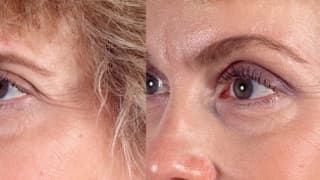 Eyebrows lifting