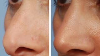 Nose plastic surgery