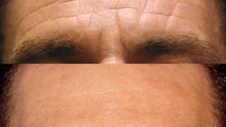 Botox application