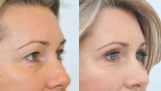 Photo - Eyelid surgery - Emilia