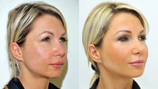 Photo - Facial slimming, contouring - Michaela