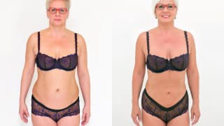 Photo - SlimLipo Laser Liposuction - Zdena