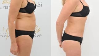 SlimLipo Laser Liposuction