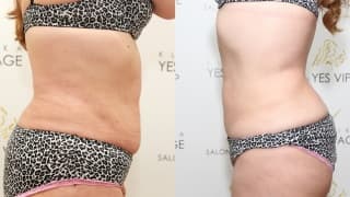 Cryolipolysis