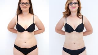 Photo - SlimLipo Laser Liposuction - Eva