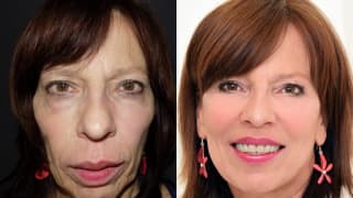 Photo - Rejuvenation, fillings - Ludmila