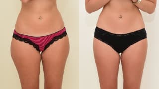 Photo - SlimLipo Laser Liposuction - Martina