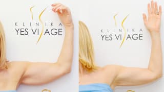 Photo - SlimLipo Laser Liposuction - Monika