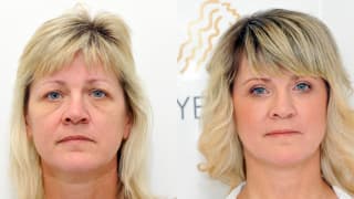 Photo - Eyelid surgery - Jana