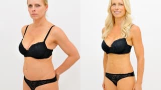 Photo - Liposuction SlimLipo - Jana
