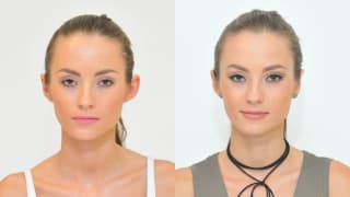 Photo - Plastic surgery of ears - Nikola
