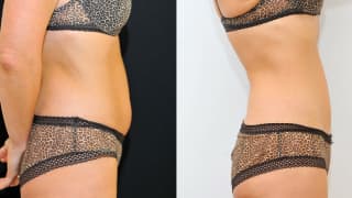 Photo - SlimLipo Laser Liposuction, Cryolipolysis - Jolana