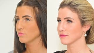 Photo - Rhinoplasty - Denisa