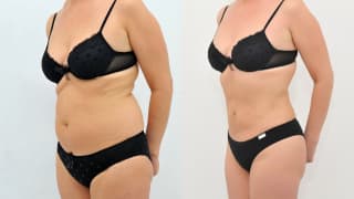 Photo - SlimLipo Laser Liposuction - Emilia