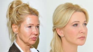 Photo - Thread lifting, facelift - Lenka