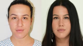 Photo – Rhinoplasty - Kristína
