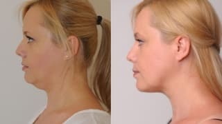 Photo - Double chin - Tereza