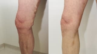 Photo - Varicose veins - Antonin
