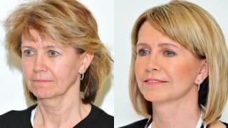 Photo - Facelift - Zdena