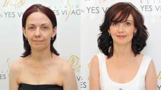 Photo - Thread lifting, hair - Jolana
