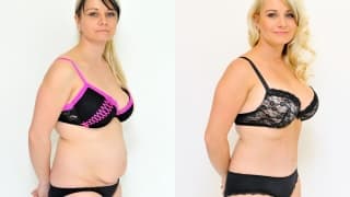 Photo - Abdominoplasty - Jarmila