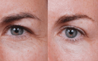 Eyelids
