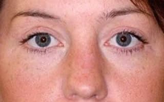 Bags and circles under the eyes