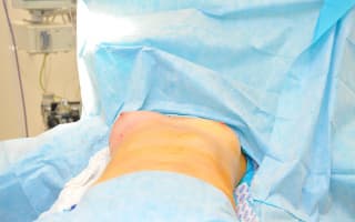 Breast Autoaugmentation