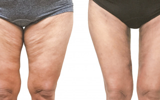 SlimLipo