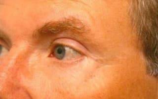 Bags and circles under the eyes