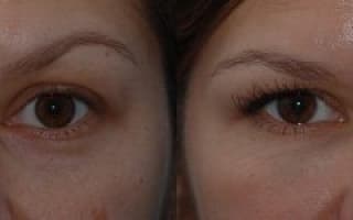 Bags and circles under the eyes