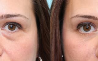 Bags and circles under the eyes