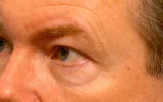 Bags and circles under the eyes
